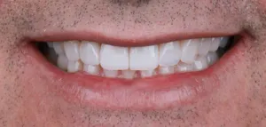 Depois - Desgaste por Bruxismo